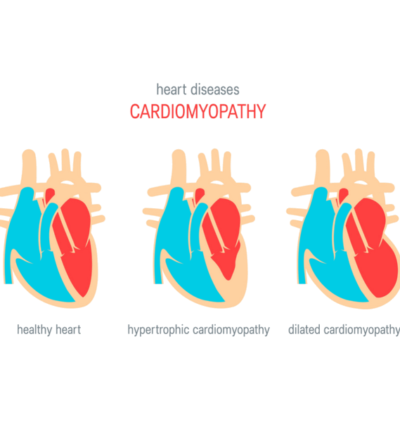 What’s the link between cardiomyopathy and blood pressure?