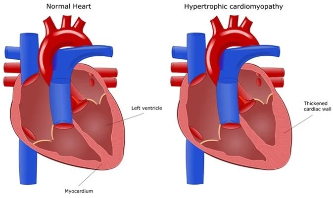 Cardiomyopathy and Blood Pressure - How Are They Linked? - 1