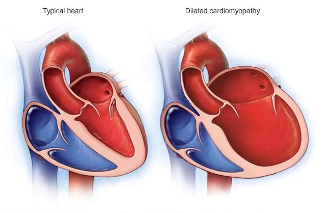 Cardiomyopathy and Blood Pressure - How Are They Linked? - 2